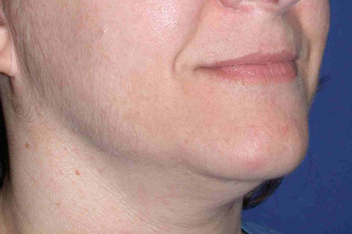 NON-SURGICAL FACE LIFT - Patient 2 - Before NON-SURGICAL FACE LIFT - Patient 2 - Before